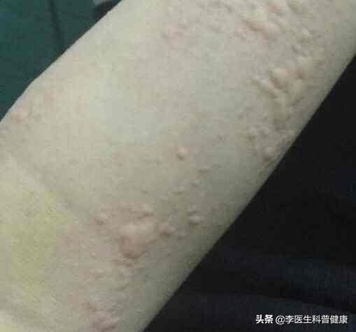 晚上發(fā)作的蕁麻疹，深入了解蕁麻疹夜發(fā)癥，蕁麻疹夜發(fā)癥深度解析